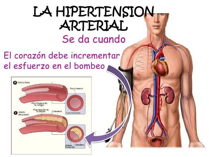 Ilustración sobre hipertensión